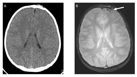 Fast Mri Technique Benefits Kids With Head Trauma