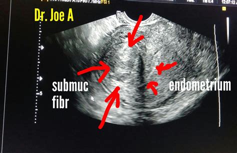 Ultrasound Imaging Submucosal Fibroid