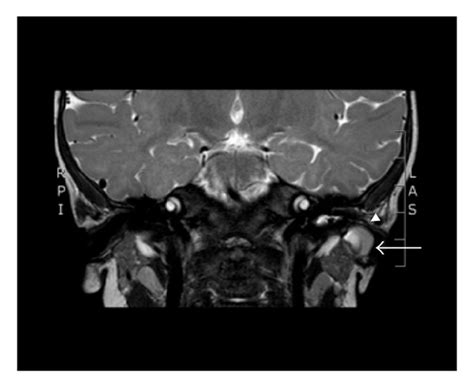 Case 5 A1 2 Ct Scan With Contrast Axial Cuts Demonstrating A