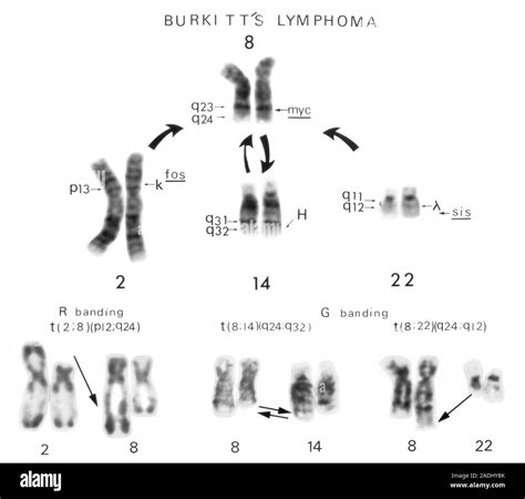 Burkitts Lymphoma Diagram Of The Translocations The Abnormal