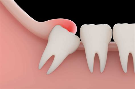 Wisdom Teeth Extraction Extract The Pain And The Tooth Edge Dental