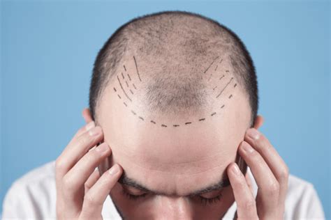 Botched Hair Transplant Caused Disfigurement Lawsuit Levin Perconti