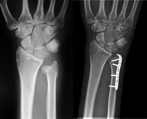 References In Distal Ulna Fractures Journal Of Hand Surgery