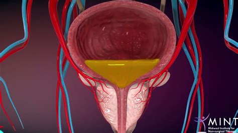 Prostate Artery Embolization Pae Video Youtube