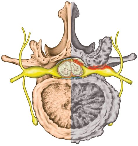 Lumbar Spinal Stenosis Spinal Stenosis Atlas Orthopaedic Group