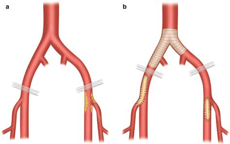 Occlusive Disease Endovascular Management Thoracic Key