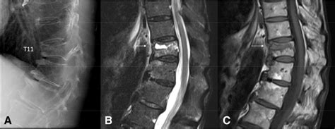 Osteoporotic Fracture Of T11 In A 78 Year Old Patient Lateral