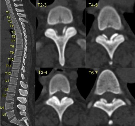 Sagittal Left And Axial Right Computed Tomography Cuts T2 T7 Of Download Scientific