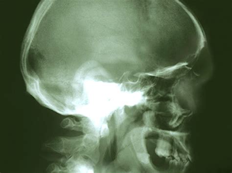 The article detailed revolutionary treatment called hifu for a rare cancer chordoma at a hospital part of h group. Reduced cancer-independent life expectancy in head, neck ...
