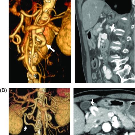 Preoperative Contrast Enhanced Computed Tomography Ct A