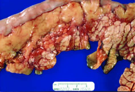 Acute interstitial pancreatitis is the milder form of pancreatitis and is marked by mild inflammation of the pancreatic parenchyma and fat necrosis. Gross appearance of the pancreas from a dog with chronic ...