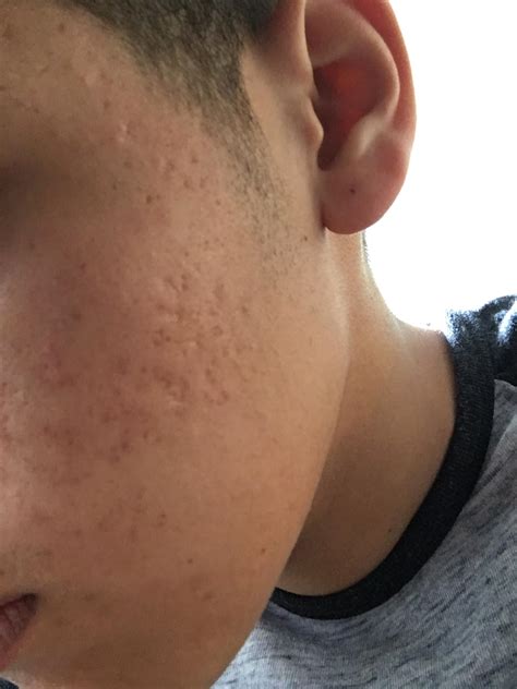 What Type Of Acne Scars Do I Have And What S The Best Treatment In Your Opinion Scar