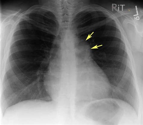 Rit Radiology Pulmonic Valvular Stenosis