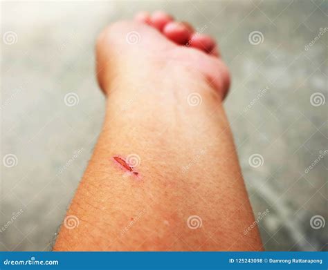 Wound Dry Scab On Skin Stock Photo Image Of Contuse 125243098