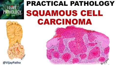 Squamous Cell Carcinoma Clinical Features And Morphology Premalignant