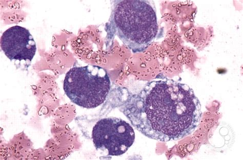 Rhabdomyosarcoma - 3.