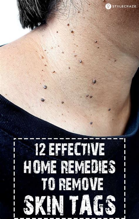 how to remove skin tags fast and safely at home proven home remedies to get rid of skin tag
