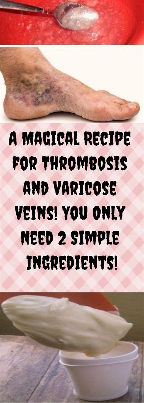 A Magical Recipe For Thrombosis And Varicose Veins You Only Need 2