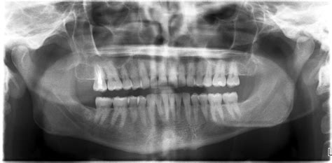 Digital Dental Xrays Dr Ari Greenspan Dentist