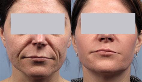 Before And After Spectralift Non Surgical Laser Facelift Nonsurgicalfacelift Skinrejuvenation