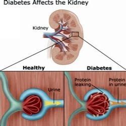 It is also extremely beneficial to consume foods that play a role in preventing diabetes complications like heart and kidney diseases. Effective Renal Diabetic Diet (With images) | Diabetic nephropathy, Diabetes education, Kidney ...
