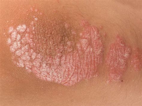 Scaling Skin Pictures Causes Treatment And Prevention
