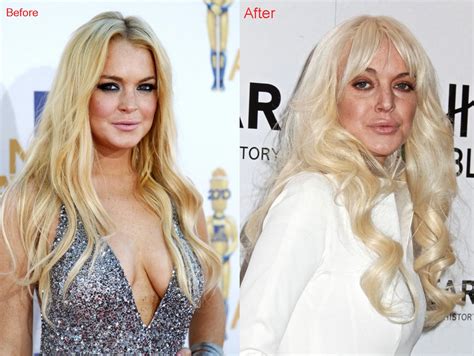 Lindsay Lohan Lip Injections Surgery Before And After