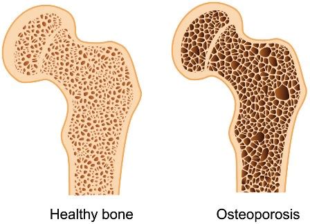 Bone mineral density (bmd) estimates the true mass of bone. Bone Densitometry