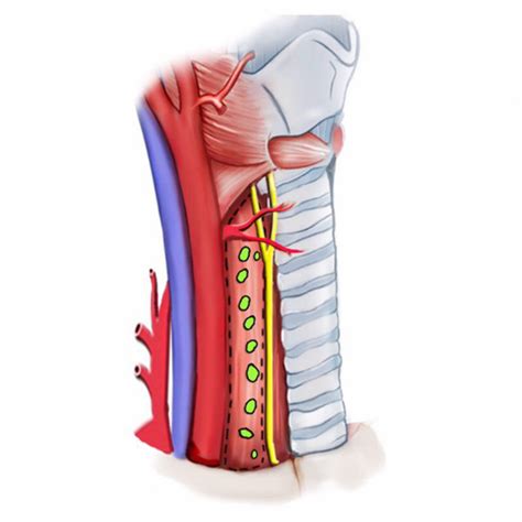 Right Cervical Central Vi 2 After Complete Lymph Node Dissection