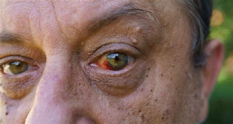 Eliminar Verrugas De Los Ojos Portal Salud