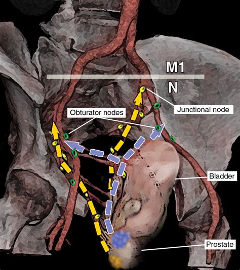 Pathways Of Lymphatic Spread In Male Urogenital Pelvic Malignancies Radiographics