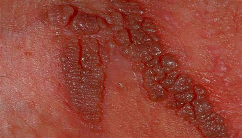 Genital Warts Summerlin Dermatology