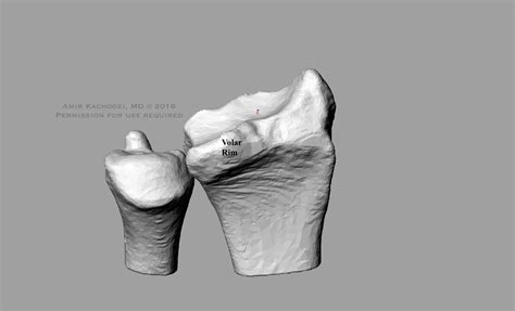 Borrowed from latin radius (ray). Distal Radius Fractures Involving The Volar Rim ...