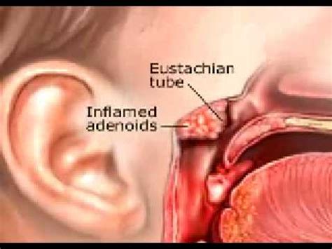 Tonsillectomy Youtube