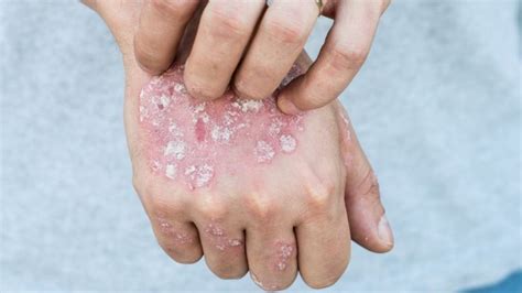 Once Considered Rare An Itchy Dermatologic Skin Disorder Is More