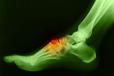 Bone Spur On Top Of Foot In Child Think You Have A Fractured Toe Here