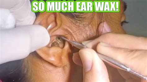 So Much Ear Wax Almost Sick Removal And Treatment Youtube