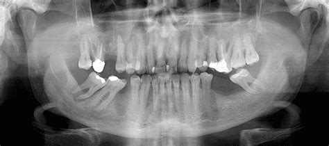 Dental X Rays Digital X Rays Belmont Nc
