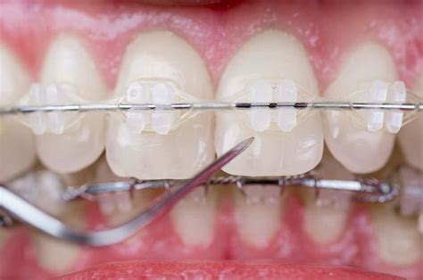Ceramic And Sapphire Braces Advantages And Differences