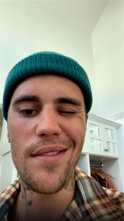 Justin Bieber Shocks Fans After He Reveals His Face Is Paralyzed By