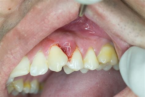 The Cavities Tooth Decay Toothache Causes Prevention Pdfs Telegraph