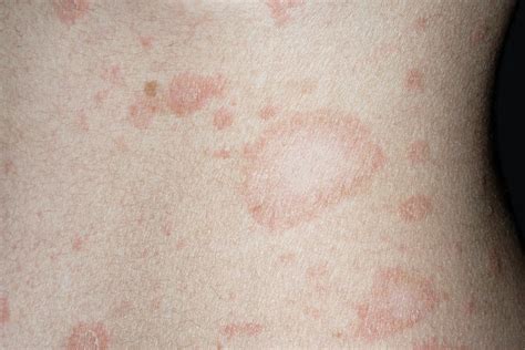 Skin Rashes In Children Nhsuk