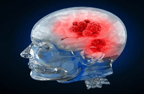 About Brain Tumors Types Symptoms Tests And Treatment Onco An