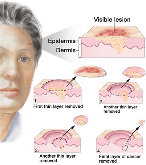 Skin Cancer Removal Manhattan Dermatology Specialists