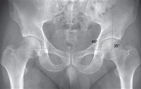 Year Old Man With Normal Left Center Edge Angle Anteroposterior Pelvic