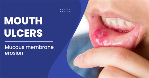 Mouth Ulcer Types Causes And Remedies