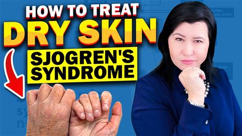 Dry Skin In Sjogrens Syndrome Youtube