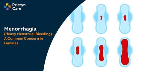 Icd 9 Abnormal Menstrual Bleeding