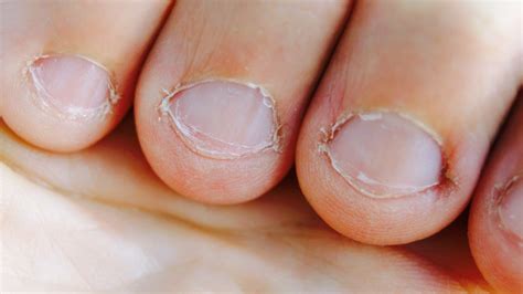 How To Stop Biting Your Nails Read This Thatsweett