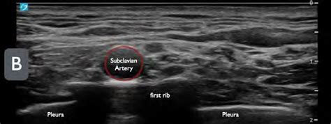 How To The Ultrasound Guided Supraclavicular Brachial Plexus Block